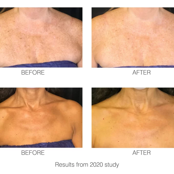 RIO DECOLITE Světelná terapie pro dekolt